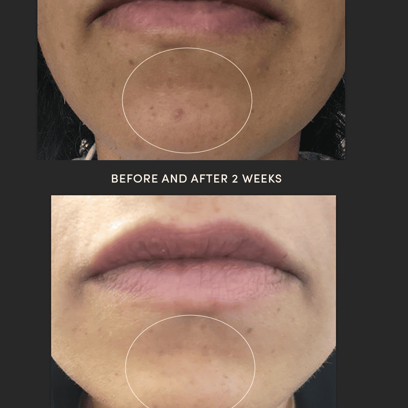 Dermacleanse® Acne Spot Treatment Gel