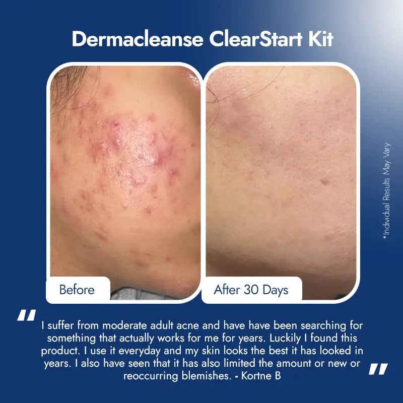 Dermacleanse ClearStart Kit