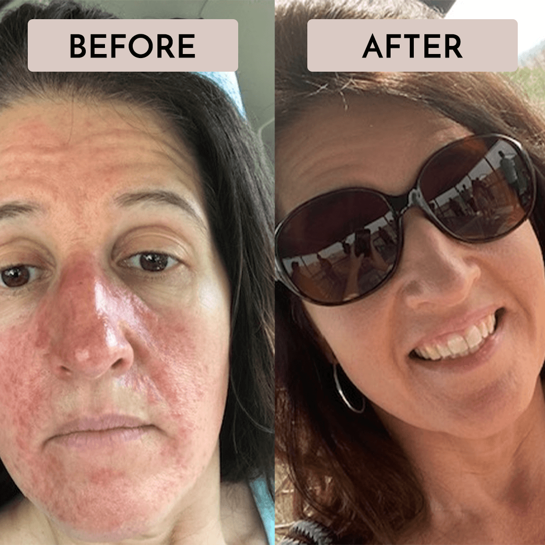 Skin Support System For Facial Redness + 2 FREE gifts worth over $60!