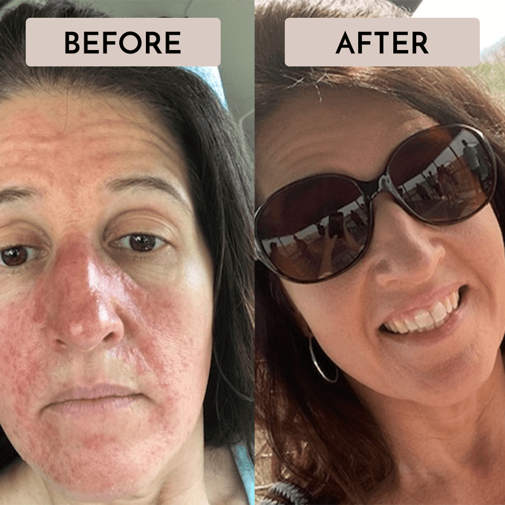 rosacea treatment, rosacea, rosacea cleanser, before and after, redness, facial redness, flushing, flareup, skin bumps