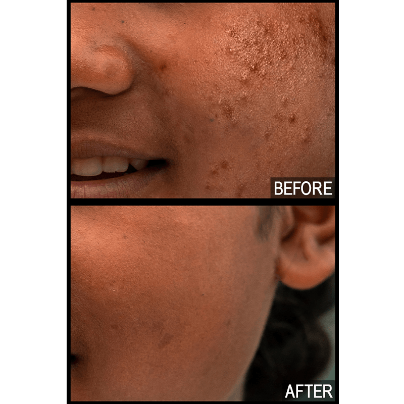 dark skin acne scar dark spots hyperpigmentation south asian skin pimples
