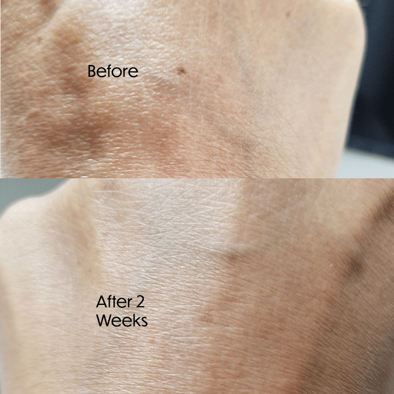 Before after using ZENMED SKINCORRECT+ Dark Spot Corrector Serum